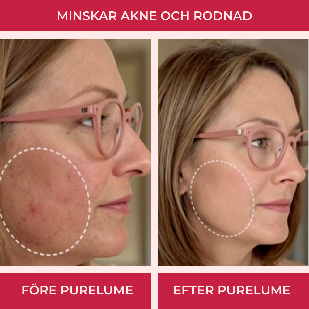 Purelume® LED-mask – 7-färgs ljusterapi för ansikte